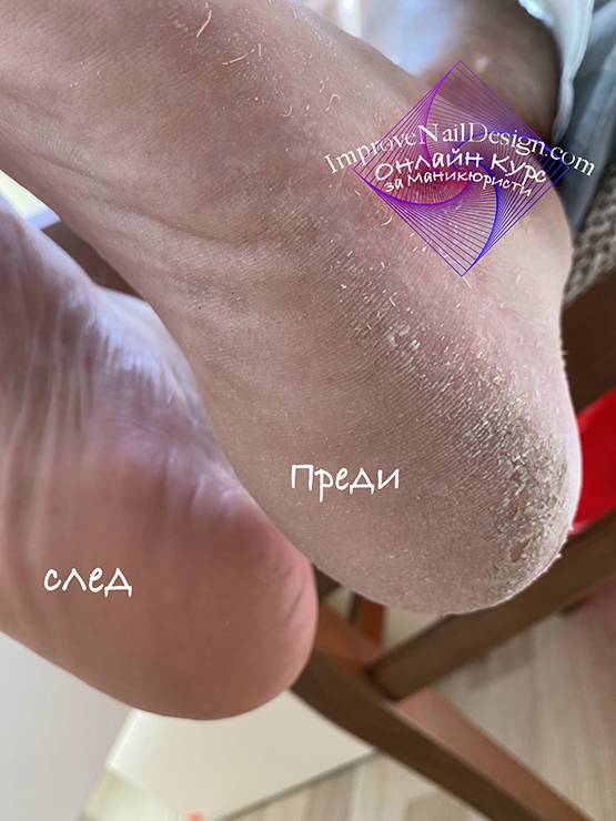 Апаратен Педикюр